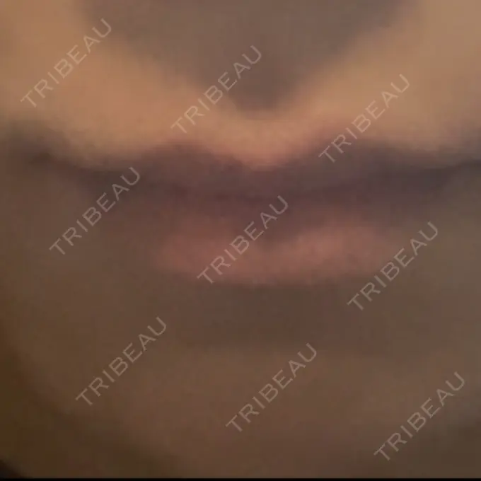 ヒアルロン酸注入（唇） アリエル美容クリニック 横浜院 DAY 2 メイン用