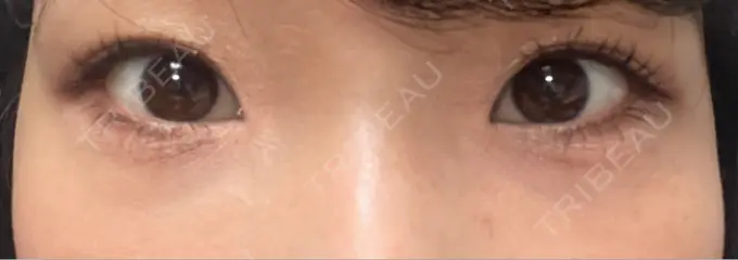 クマ治療 BELLMONA CLINIC AFTER メイン用