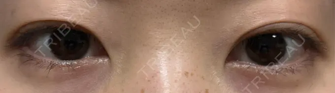 二重埋没 聖心美容クリニック 六本木院 AFTER メイン用