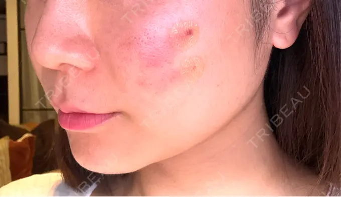 サブシジョン コスメディカルクリニック シンシア 渋谷院 DAY 0 メイン用