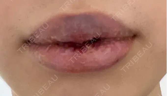 口唇縮小術 高須クリニック 大阪院 DAY 10 メイン用