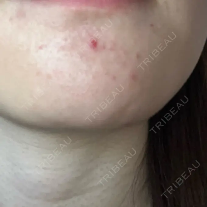 アグネス オラクル美容皮膚科 福岡天神院 AFTER メイン用