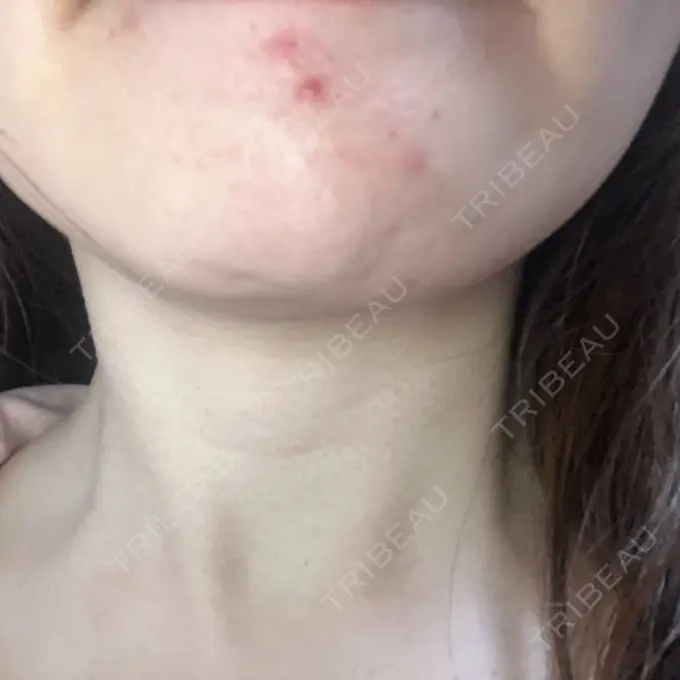 アグネス オラクル美容皮膚科 福岡天神院 DAY 1 メイン用