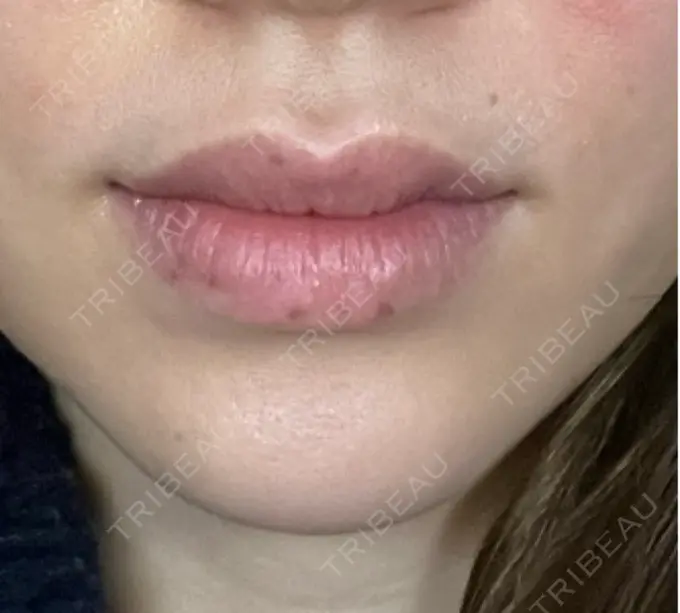 シミ取りレーザー / その他（口元） Wクリニック 梅田院 DAY 9 メイン用