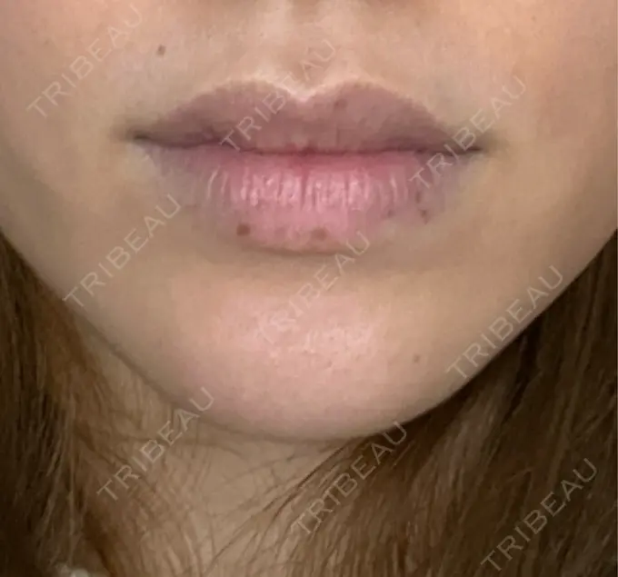 シミ取りレーザー / その他（口元） Wクリニック 梅田院 DAY 10 メイン用