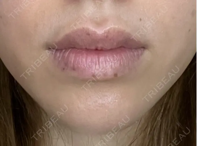 シミ取りレーザー / その他（口元） Wクリニック 梅田院 AFTER メイン用