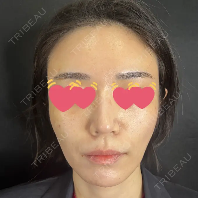 サブシジョン 藤・ナチュレ美容クリニック 銀座院 AFTER メイン用