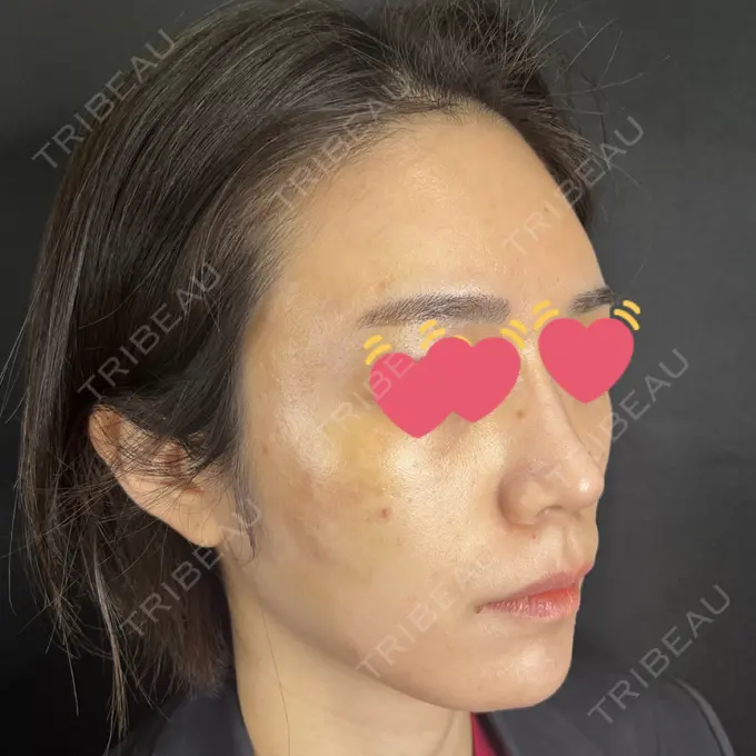 サブシジョン 藤・ナチュレ美容クリニック 銀座院 DAY 9 メイン用