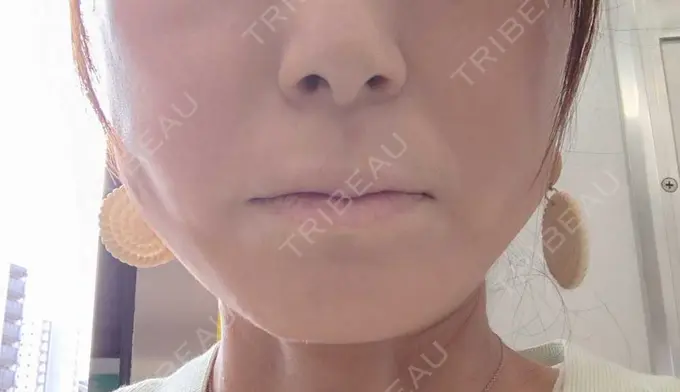 糸リフト / ボトックス（エラ・小顔） / ピーリング（ハリ・ツヤ） アリエル美容クリニック 横浜院 DAY 5 メイン用