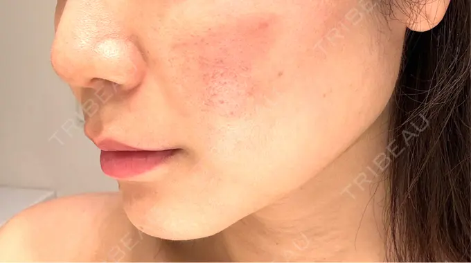 サブシジョン コスメディカルクリニック シンシア 渋谷院 DAY 1 メイン用