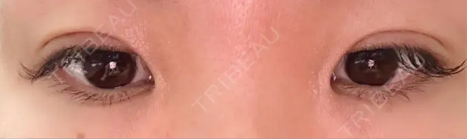 二重埋没 水の森美容クリニック 東京銀座院 DAY 3 メイン用