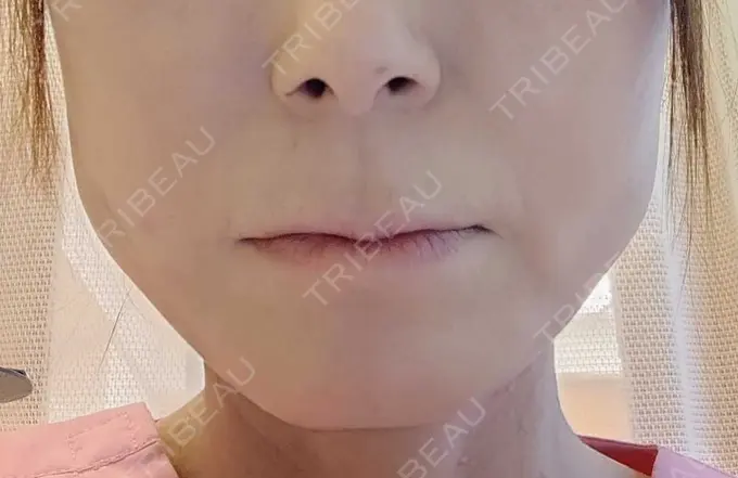 糸リフト / ボトックス（エラ・小顔） / ピーリング（ハリ・ツヤ） アリエル美容クリニック 横浜院 DAY 6 メイン用