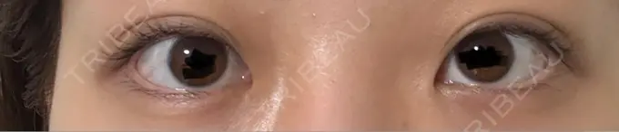 二重埋没 / 目元修正 水の森美容クリニック 東京渋谷院 DAY 21 メイン用