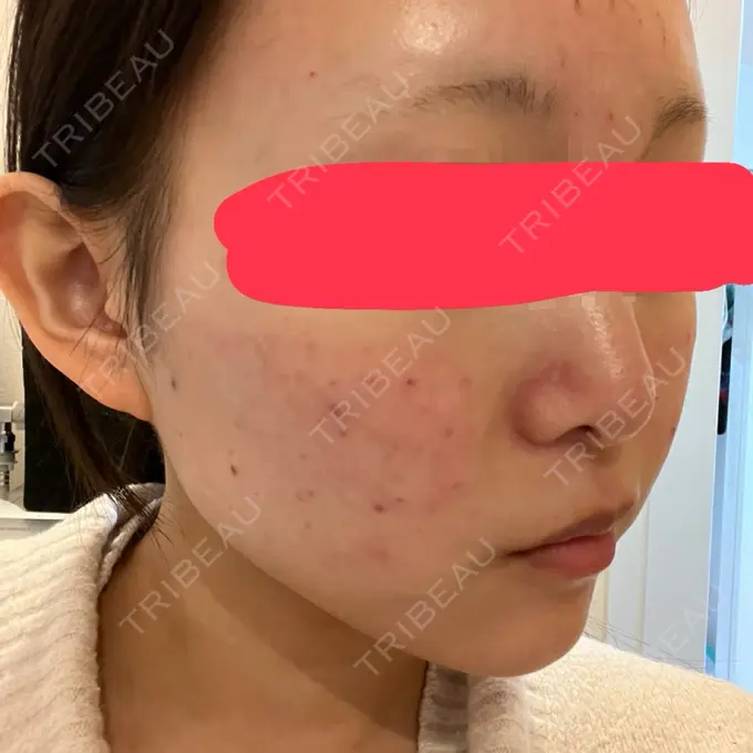 肌育注射（ジュベルックなど） 城本クリニック 池袋院 DAY 0 メイン用