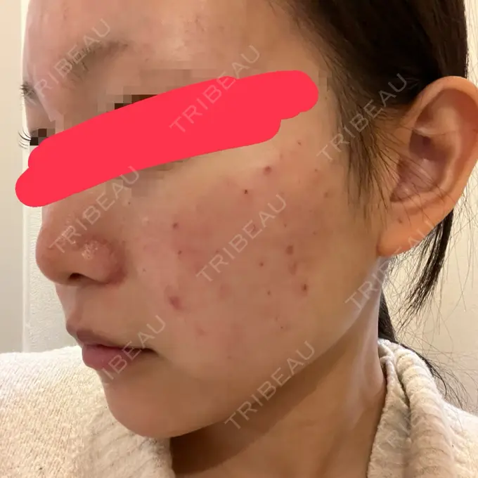 肌育注射（ジュベルックなど） 城本クリニック 池袋院 DAY 0 メイン用