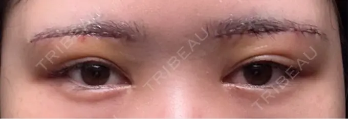 眉下切開 もとび美容外科クリニック 新宿院 DAY 2 メイン用