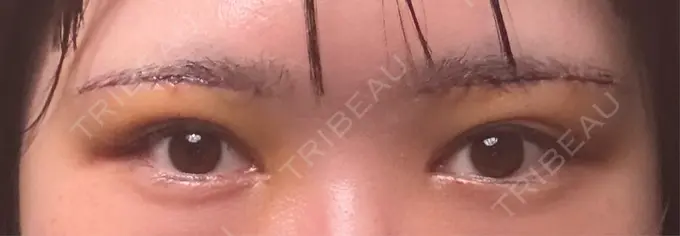 眉下切開 もとび美容外科クリニック 新宿院 DAY 3 メイン用