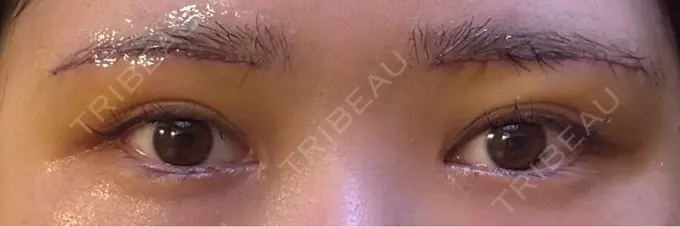 眉下切開 もとび美容外科クリニック 新宿院 DAY 4 メイン用