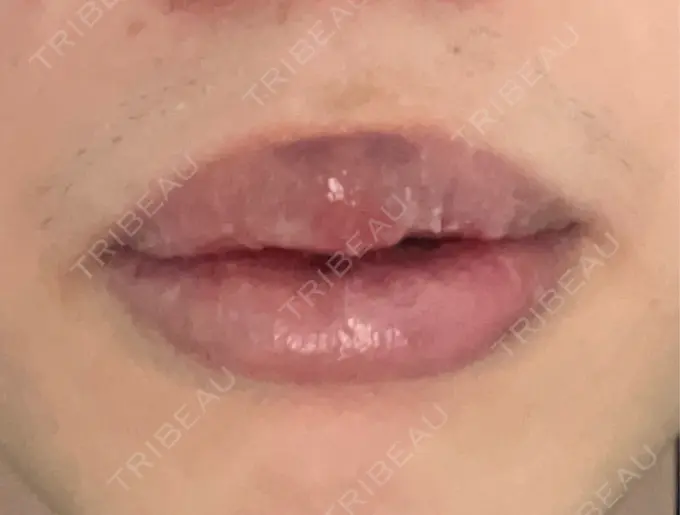 口唇縮小術 高須クリニック 大阪院 DAY 12 メイン用
