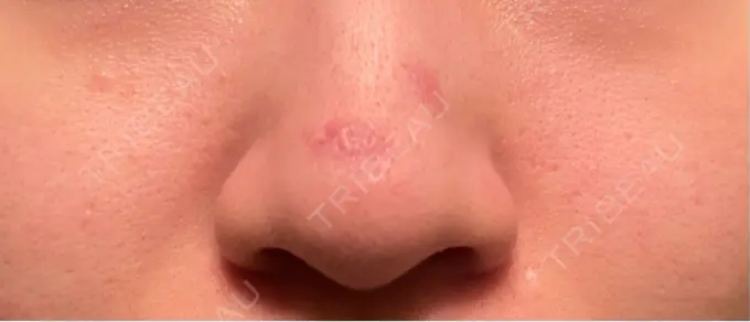 ボトックス（あご） / ボトックス（エラ・小顔） / ボトックス（眉間） / ボトックス（額） / サブシジョン 藤・ナチュレ美容クリニック 銀座院 DAY 6 メイン用