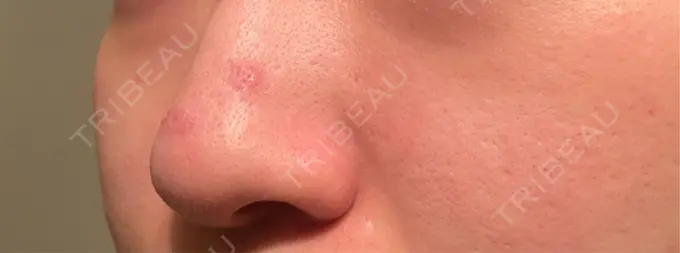 ボトックス（あご） / ボトックス（エラ・小顔） / ボトックス（眉間） / ボトックス（額） / サブシジョン 藤・ナチュレ美容クリニック 銀座院 DAY 6 メイン用