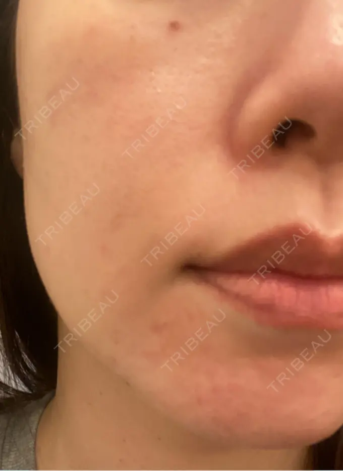 イオン導入 / レーザートーニング（美白・肝斑） MAクリニック 心斎橋 DAY 0 メイン用