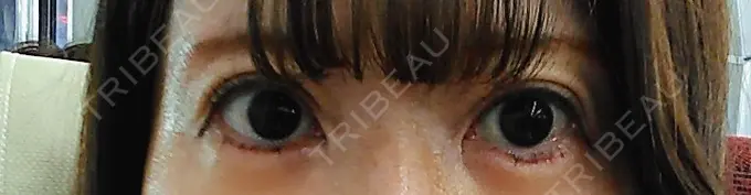 糸リフト / タレ目形成・グラマラスライン（切開） / ボトックス（あご） 品川スキンクリニック広島院 DAY 6 メイン用