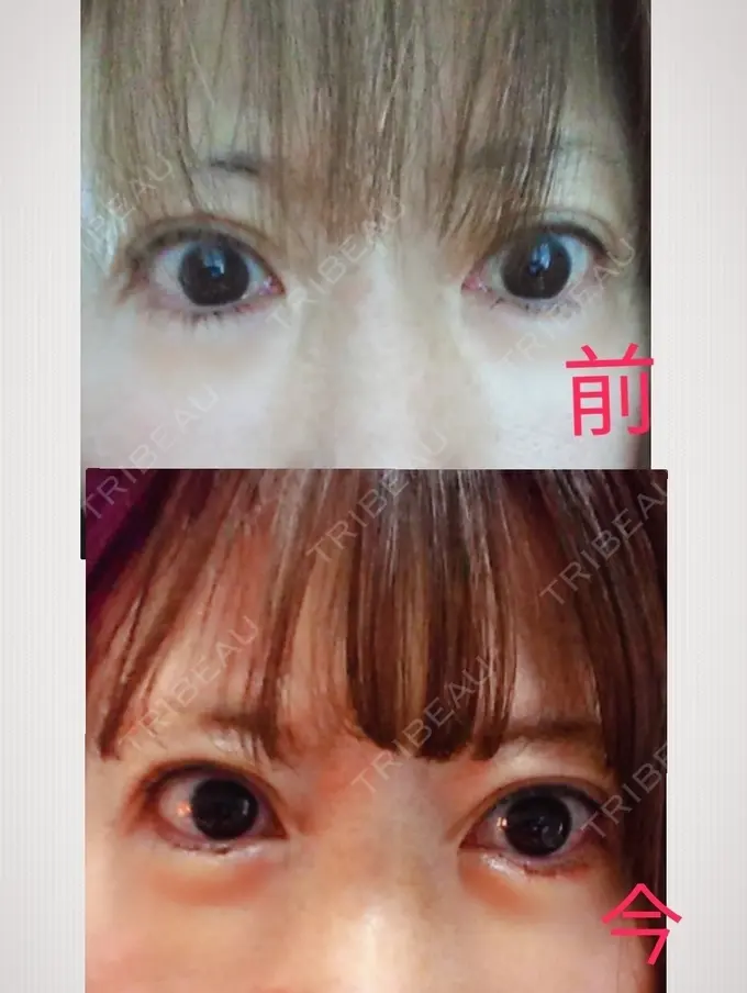 糸リフト / タレ目形成・グラマラスライン（切開） / ボトックス（あご） 品川スキンクリニック広島院 AFTER メイン用