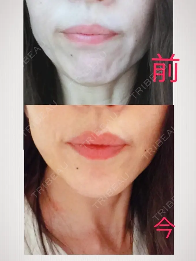 糸リフト / タレ目形成・グラマラスライン（切開） / ボトックス（あご） 品川スキンクリニック広島院 DAY 7 メイン用