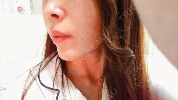 糸リフト / タレ目形成・グラマラスライン（切開） / ボトックス（あご） 品川スキンクリニック広島院 DAY 7 メイン用