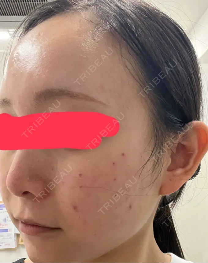 肌育注射（ジュベルックなど） 城本クリニック 池袋院 DAY 1 メイン用