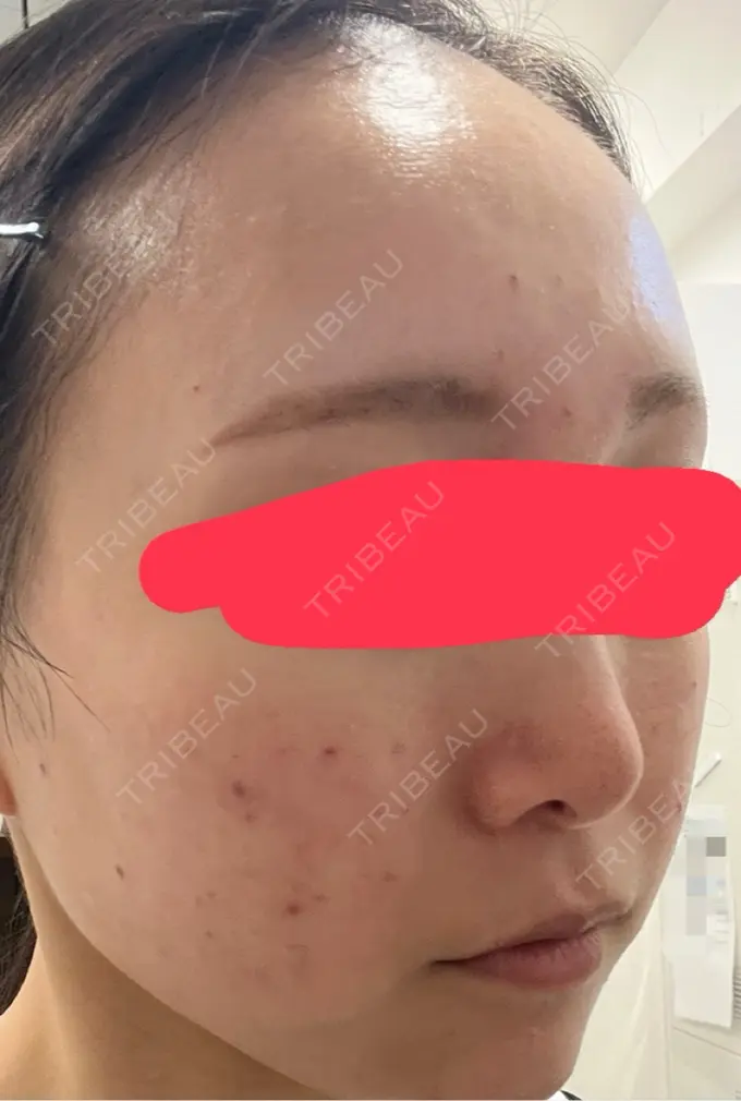 肌育注射（ジュベルックなど） 城本クリニック 池袋院 DAY 1 メイン用