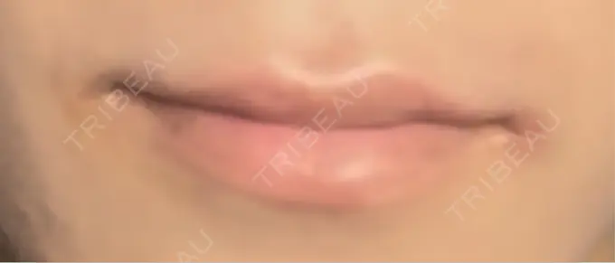 ヒアルロン酸注入（唇） アリエル美容クリニック 横浜院 DAY 4 メイン用