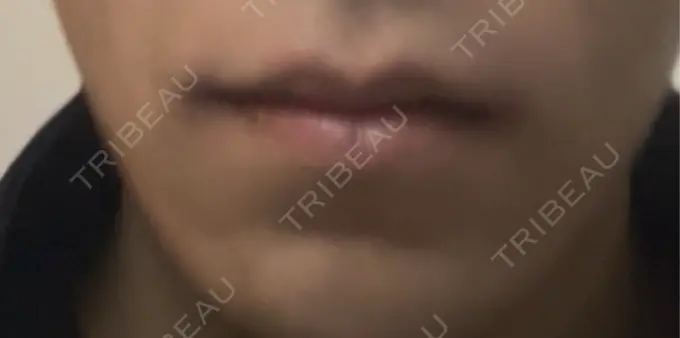 ヒアルロン酸注入（唇） アリエル美容クリニック 横浜院 DAY 5 メイン用