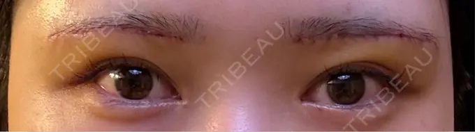 眉下切開 もとび美容外科クリニック 新宿院 DAY 5 メイン用