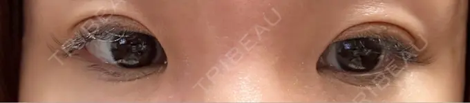 二重埋没 水の森美容クリニック 東京銀座院 DAY 5 メイン用