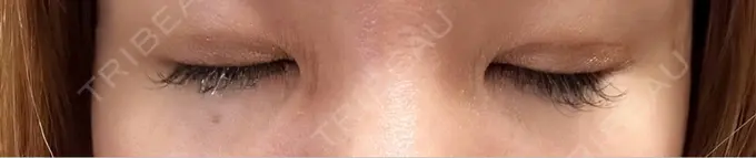 二重埋没 水の森美容クリニック 東京銀座院 DAY 5 メイン用