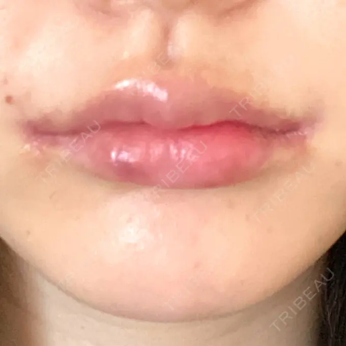 人中短縮 / 口角挙上 R Beauty CLINIC 銀座院 DAY 35 メイン用