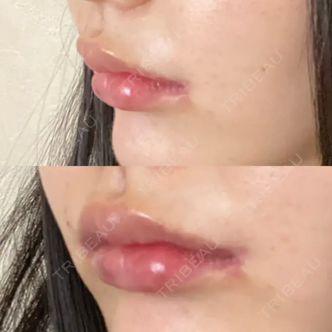 人中短縮 / 口角挙上 R Beauty CLINIC 銀座院 DAY 35 メイン用