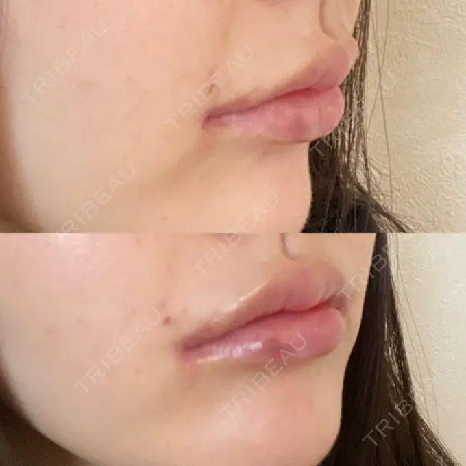 人中短縮 / 口角挙上 R Beauty CLINIC 銀座院 DAY 35 メイン用