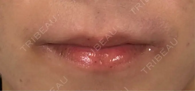 ヒアルロン酸注入（唇） アリエル美容クリニック 横浜院 AFTER メイン用