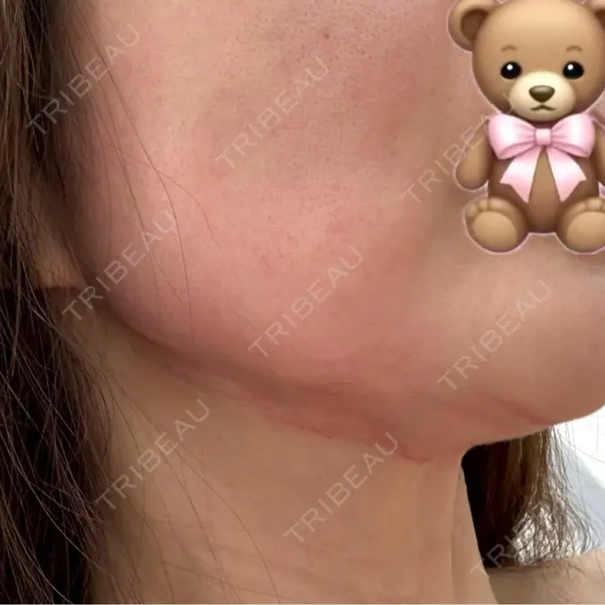 RF（高周波）たるみ治療 PureMe Skin Clinic（ピュアミースキンクリニック麻布） DAY 0 メイン用