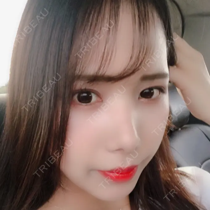 二重埋没 / 骨切り（あご） / 骨削り（頬） / 軟骨移植 / 骨切幅寄せ バノバギ整形外科 DAY 143 メイン用