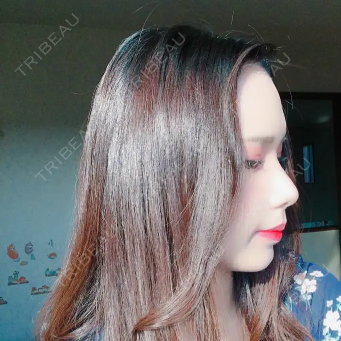 二重埋没 / 骨切り（あご） / 骨削り（頬） / 軟骨移植 / 骨切幅寄せ バノバギ整形外科 DAY 143 メイン用