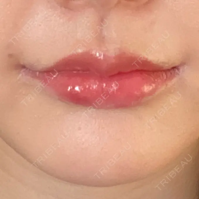 人中短縮 / 口角挙上 R Beauty CLINIC 銀座院 DAY 35 メイン用