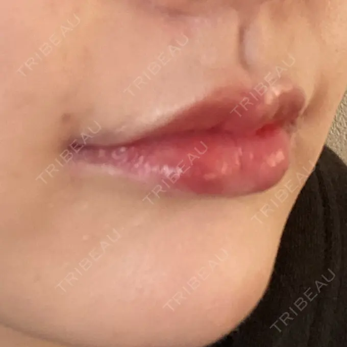 人中短縮 / 口角挙上 R Beauty CLINIC 銀座院 DAY 35 メイン用