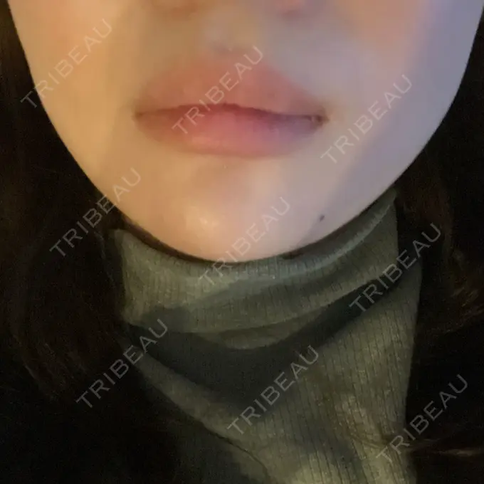 ヒアルロン酸注入（あご） / ボトックス（エラ・小顔） フィラークリニック 名古屋栄院 DAY 1 メイン用