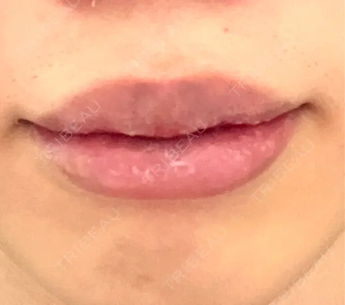 口唇縮小術 高須クリニック 大阪院 AFTER メイン用