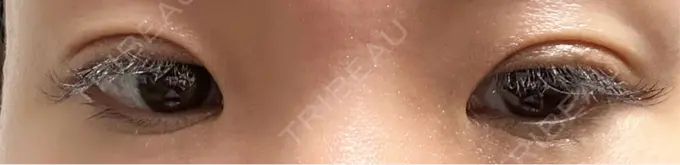 二重埋没 水の森美容クリニック 東京銀座院 DAY 6 メイン用