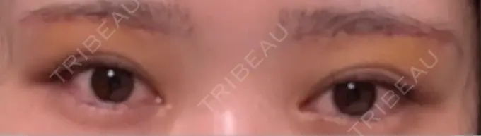 眉下切開 もとび美容外科クリニック 新宿院 DAY 6 メイン用